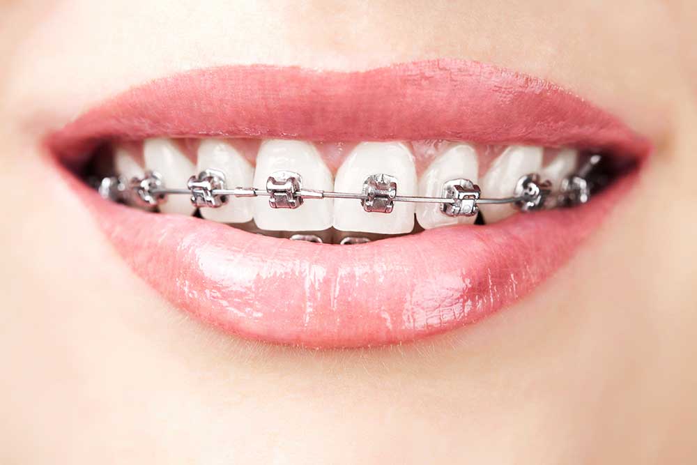 tratamiento de ortodoncia fija brackets