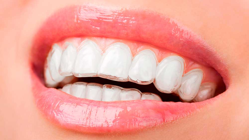 Ortodoncia invisible dentista sevilla