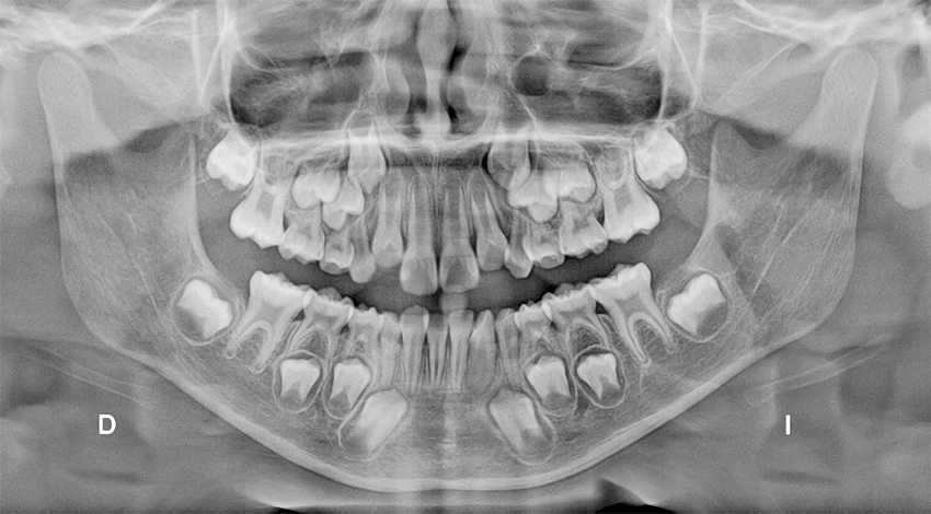 Radiografia_dosfilas_dentista_sevilla