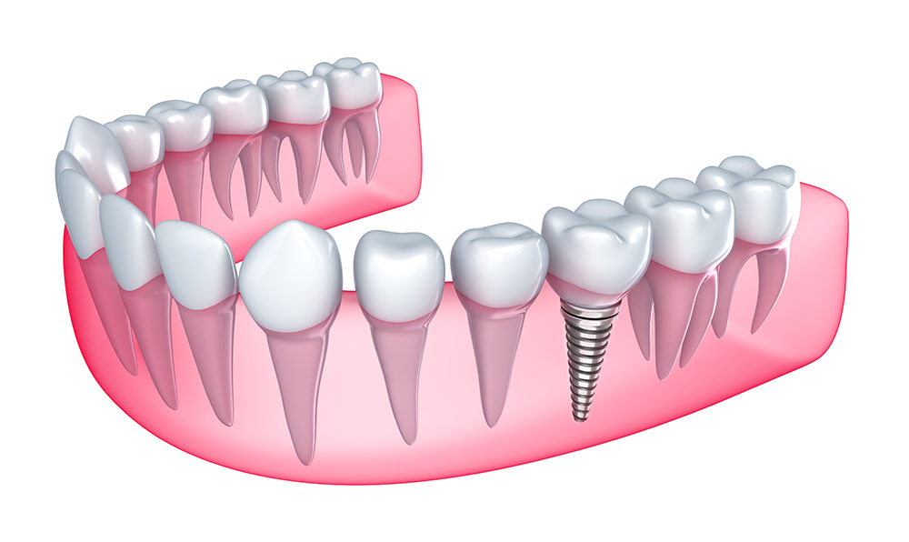 tratamiento implante dental en sevilla