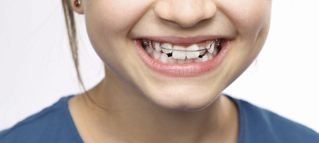 Ortodoncia interceptiva: corrigiendo la sonrisa de tus hijos a tiempo