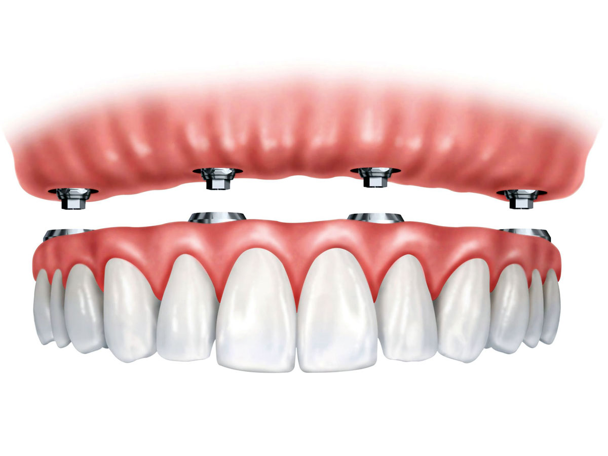 Implantes dentales de carga inmediata: dientes fijos en un solo día